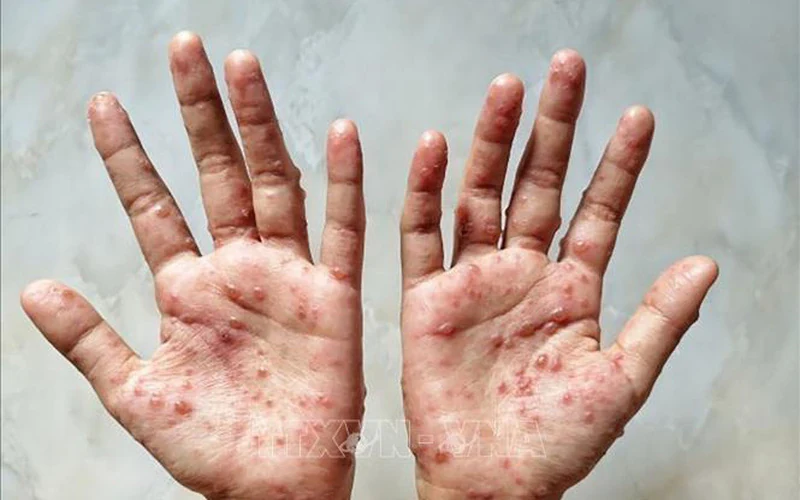 Tăng cường phòng chống bệnh đậu mùa khỉ